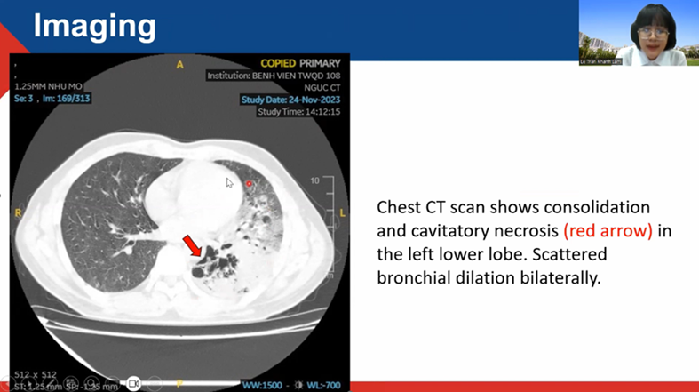 Lung Cancer Resembling Pneumonia